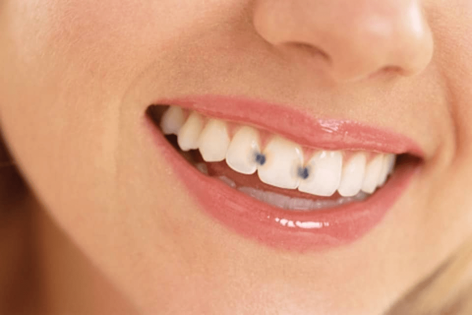 cavities between teeth